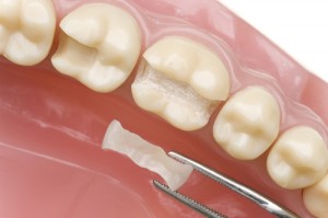 Inlays and Onlays Treatment - Museum Dental Suites