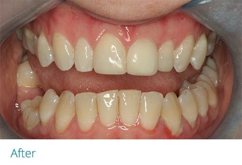 Invisalign and composite bonding after2 - Museum Dental Suites