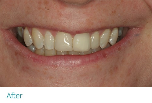 Invisalign and composite bonding after1 - Museum Dental Suites