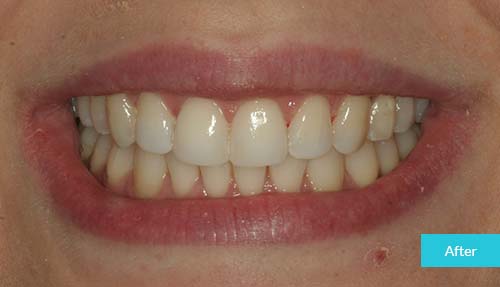 Teeth whitening & bonding after 2