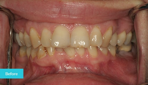 Composite bonding in London Ontario - Sbenati Dentistry