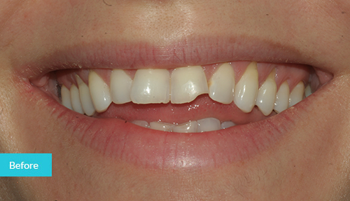 Teeth whitening & bonding before 2