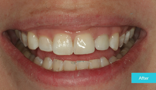 Composite Bonding Case after 1