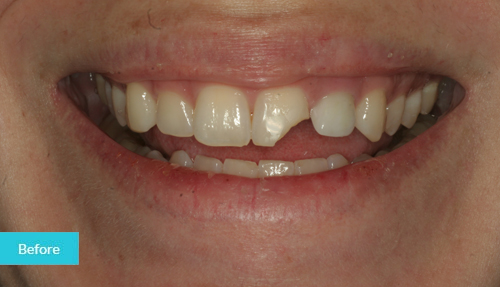 Composite Bonding Case before 1