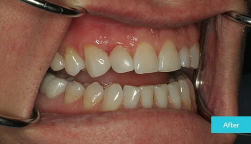 Dental Bonding to Close a Gap After