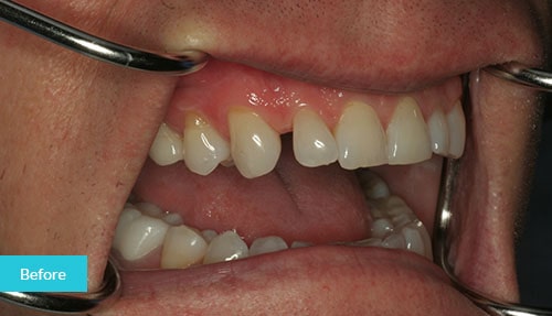 >Dental Bonding to Close a Gap before