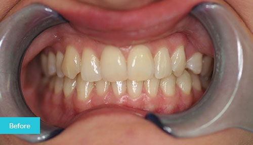 Invisalign Before