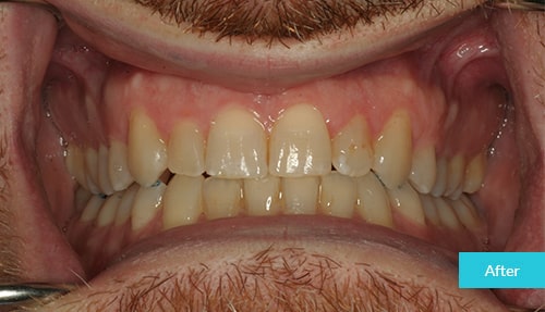 Full Invisalign After