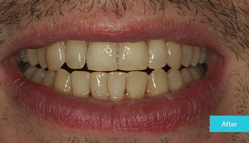 Invisalign After 9