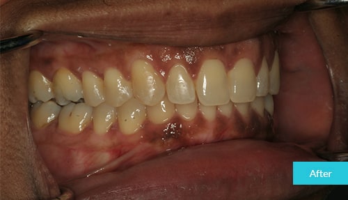Invisalign After 10