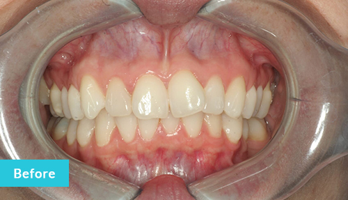 Invisalign and Contouring before 2