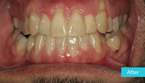 gap teeth fixed with invisalign after