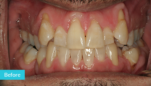 gap teeth before invisalign