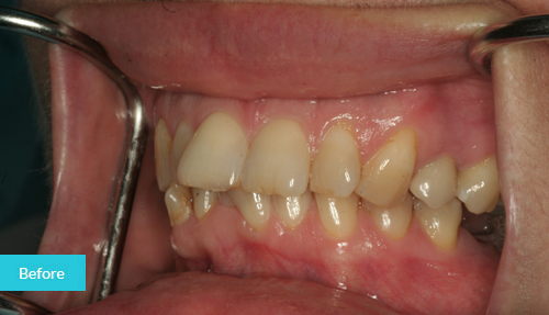 upper veneers to better shape and alignment of teeth Befor