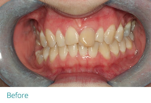 Invisalign and composite bonding before2 - Museum Dental Suites