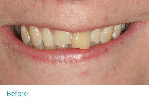 Invisalign and composite bonding before1 - Museum Dental Suites
