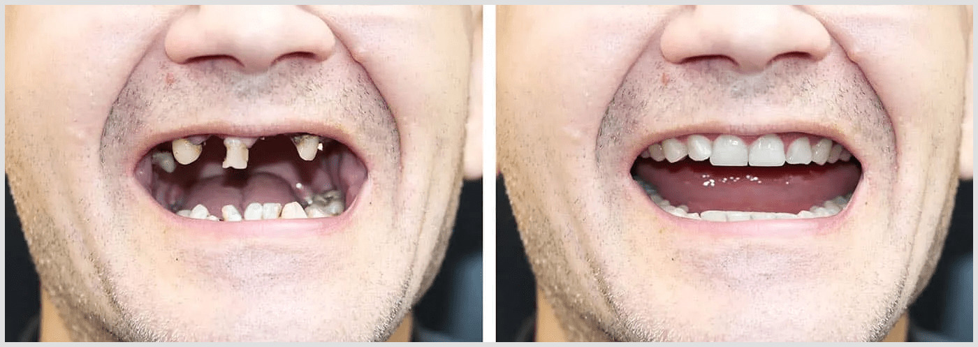 invisalign before 2