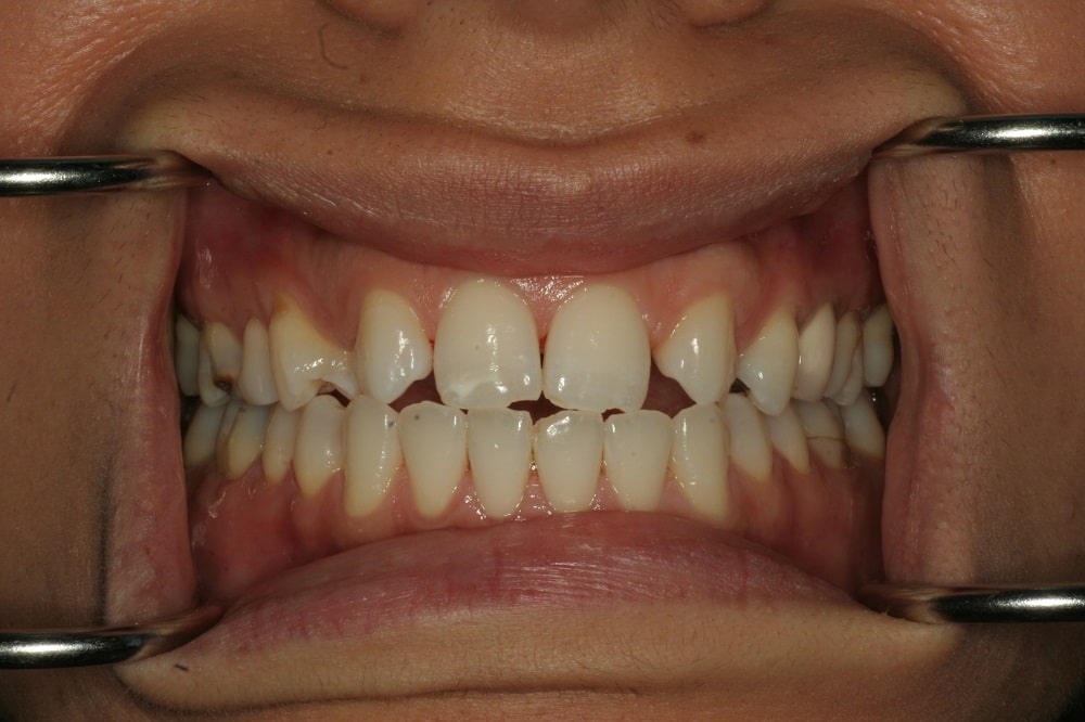 Amazing case of invisalign