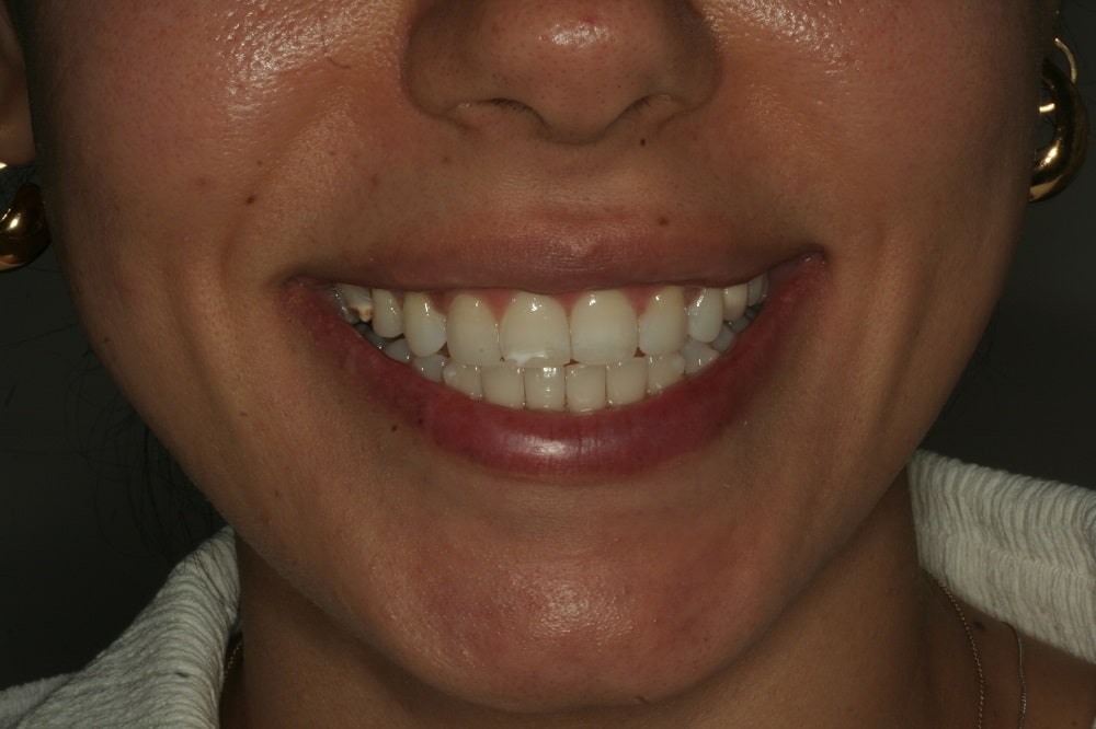 Amazing case of invisalign