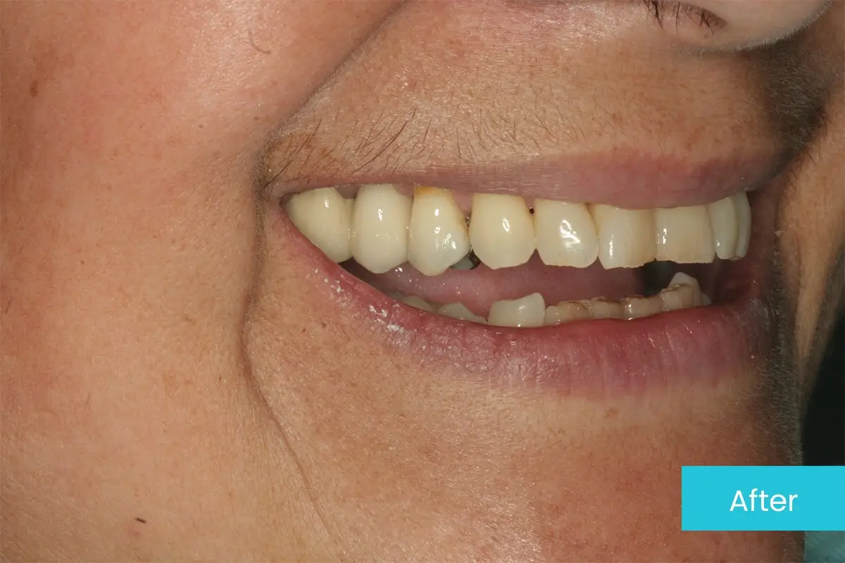 Dental bridge to replace a gap After