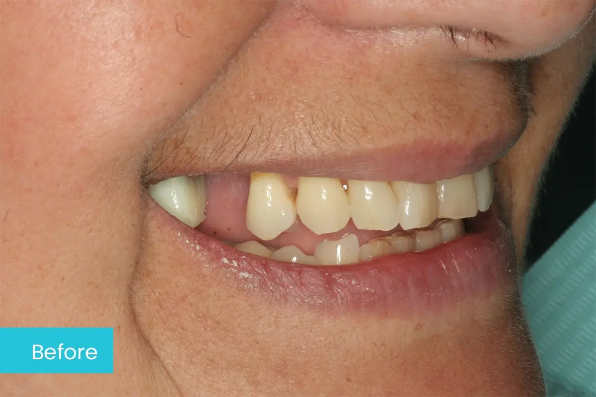 Dental bridge to replace a gap Before