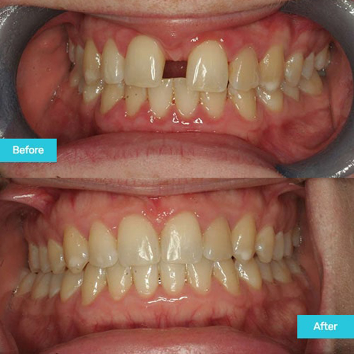 invisalign-case-4-home