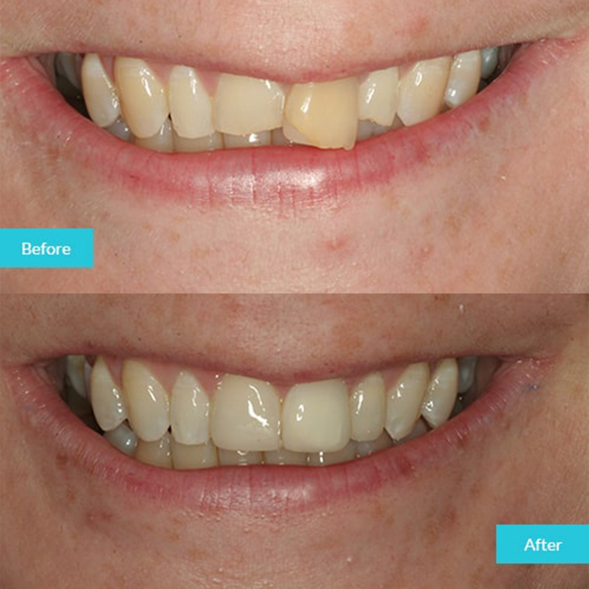 invisalign-case-5-home