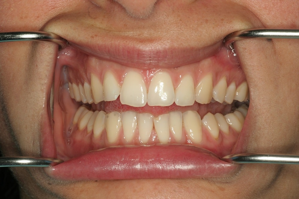 invisalign Lite and whitening case