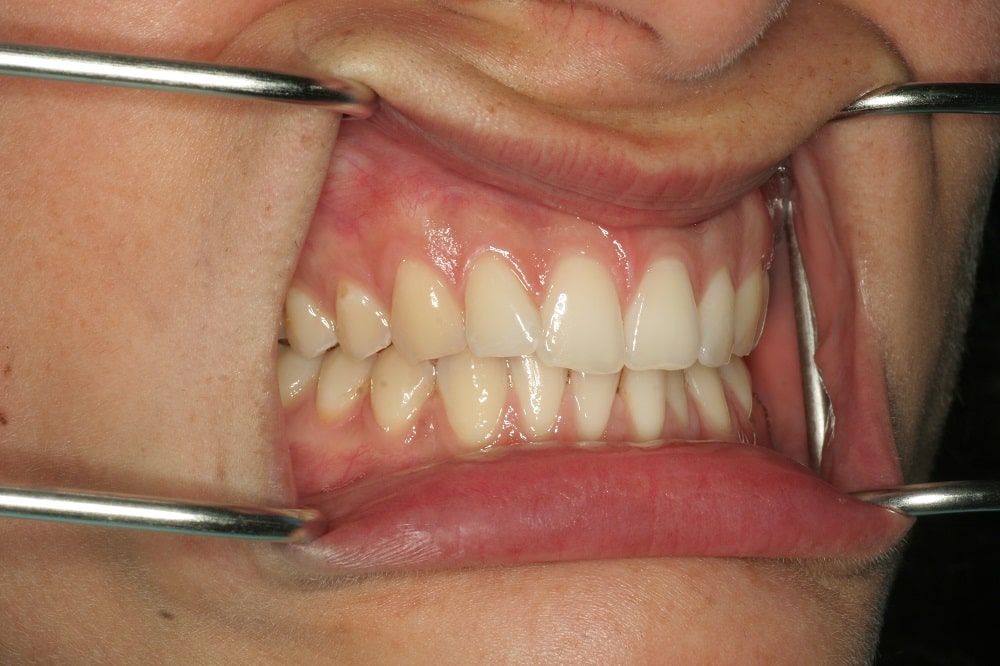 invisalign Lite and whitening case