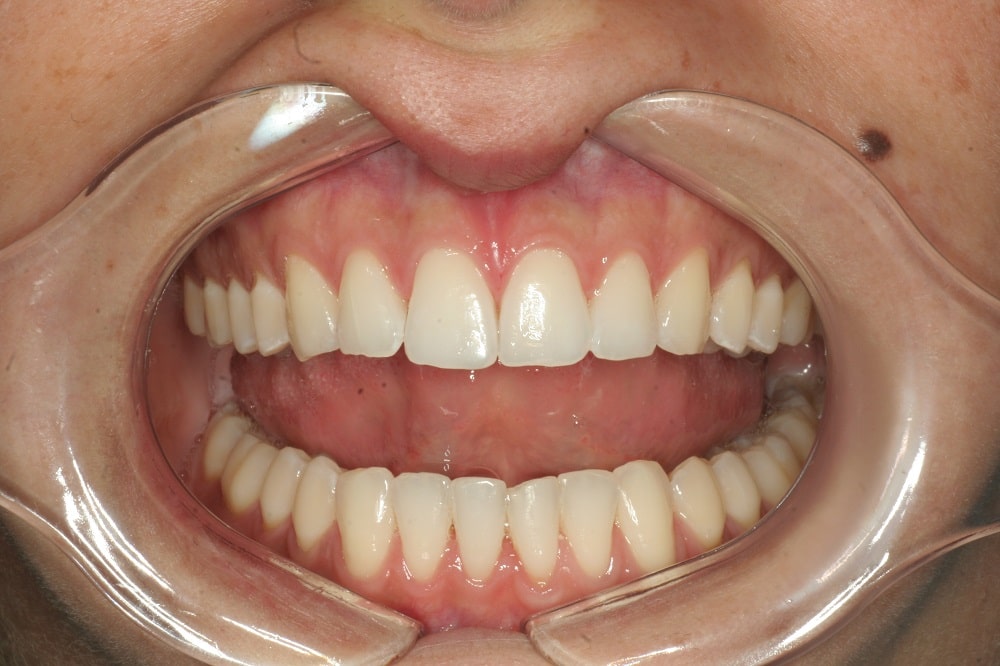 invisalign Lite and whitening case