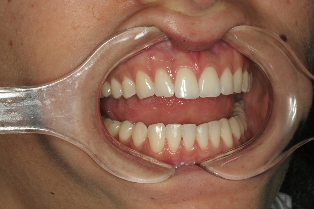 invisalign Lite and whitening case