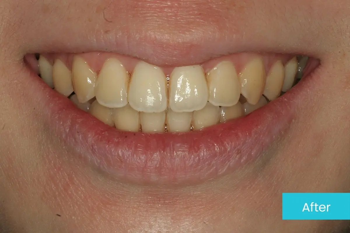 Invisalign 1 After