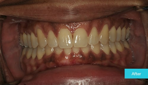 Invisalign After 10