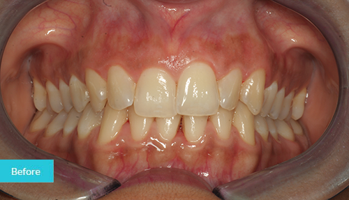 invisalign and teeth whitening before