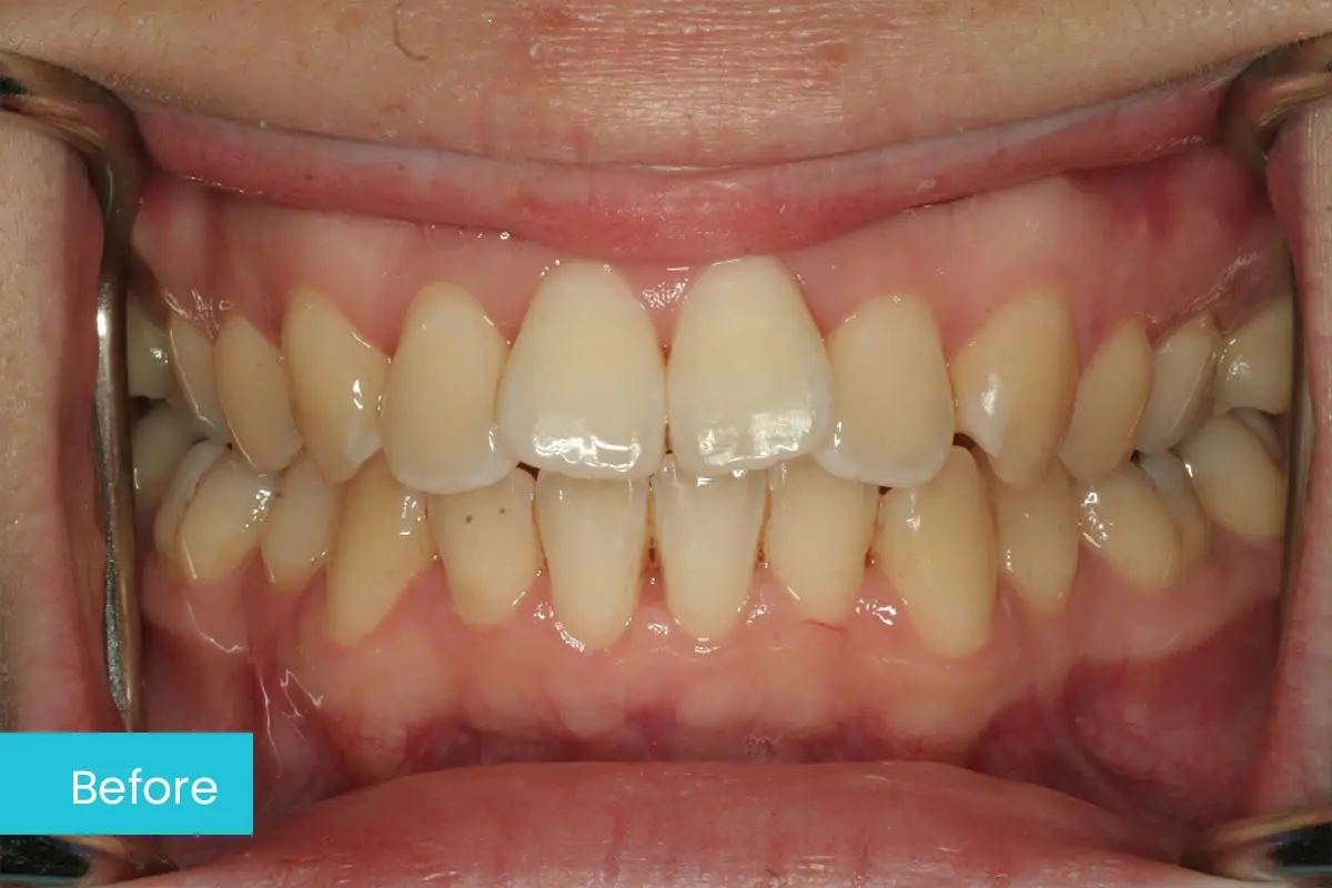 Invisalign 1 Before