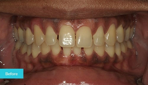 Invisalign Before 10