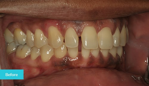 Invisalign Before 9