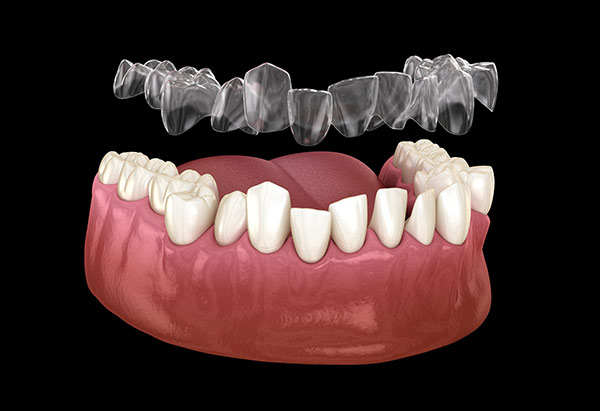 Invisalign for Open Bite