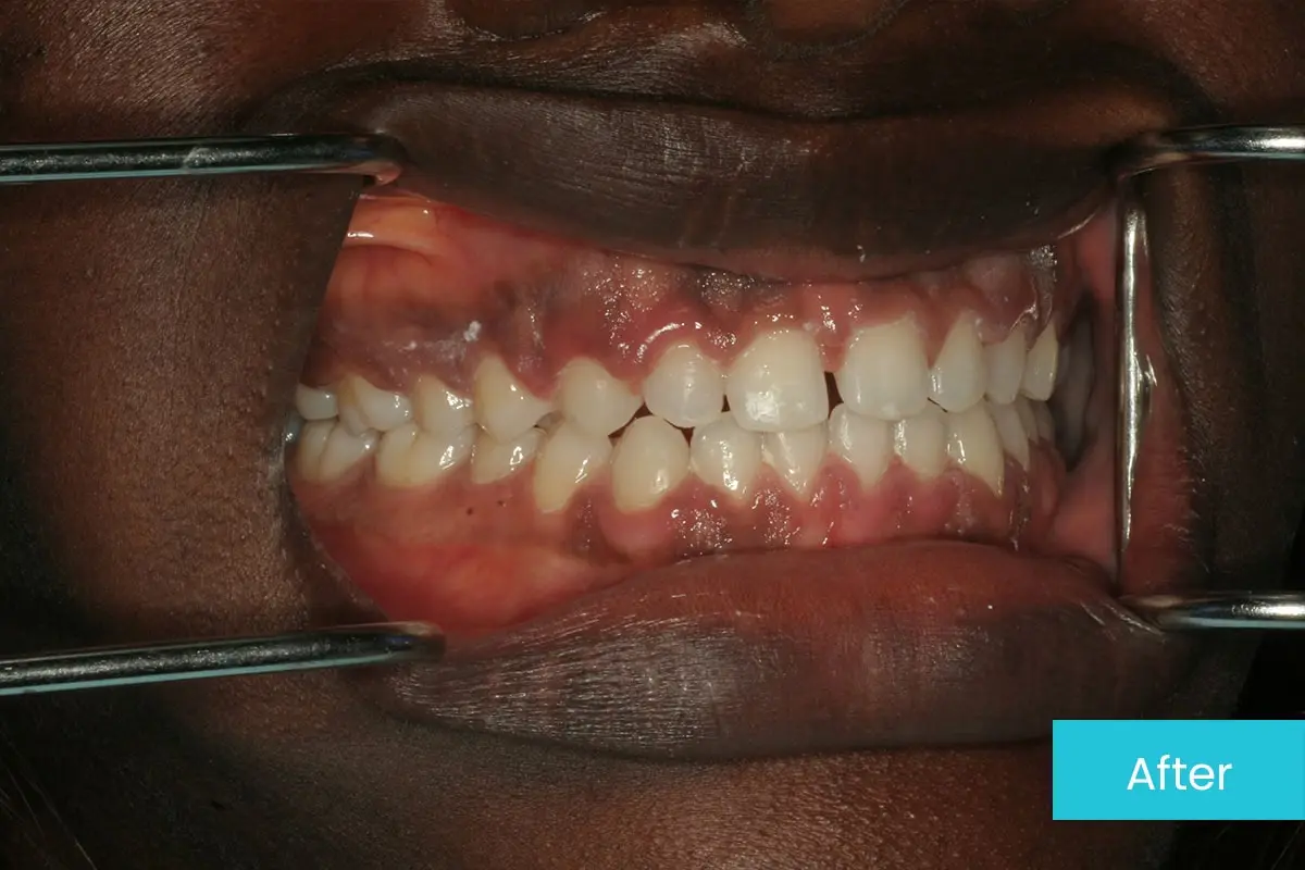 Invisalign For Open Bite Case 1 After