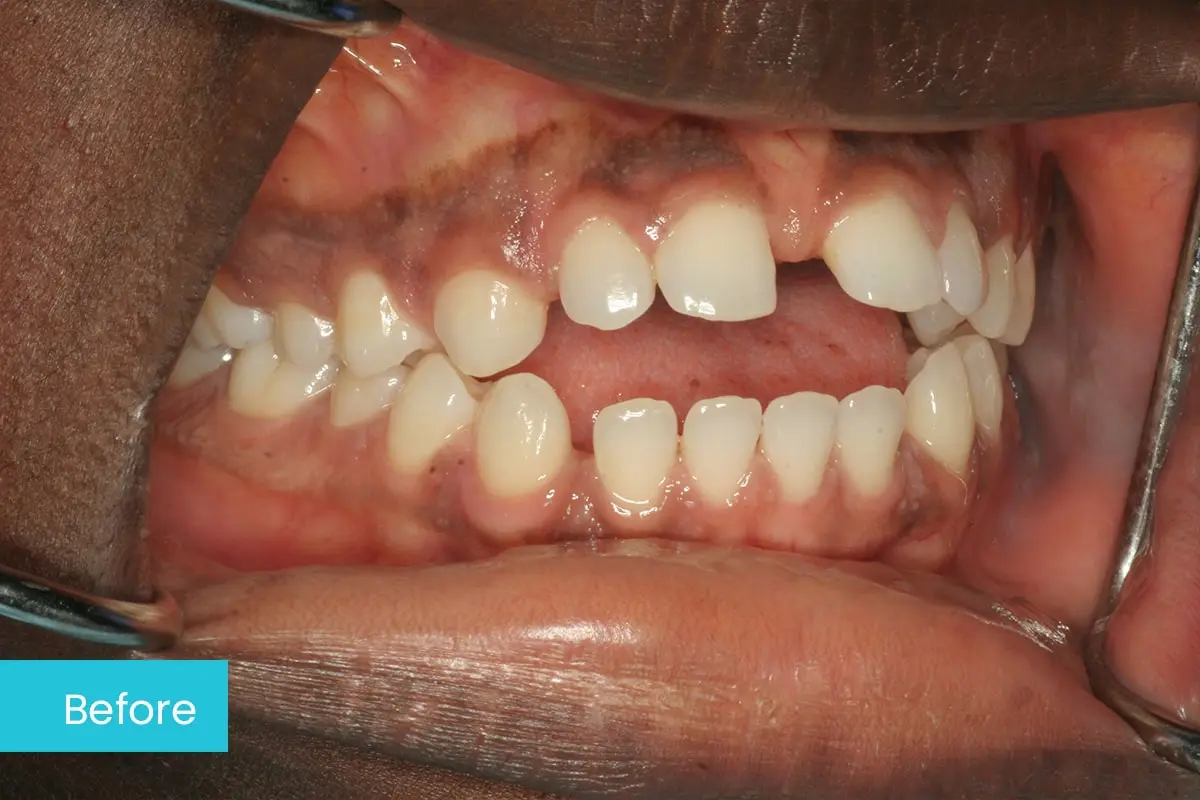 Invisalign For Open Bite Case 1 Before