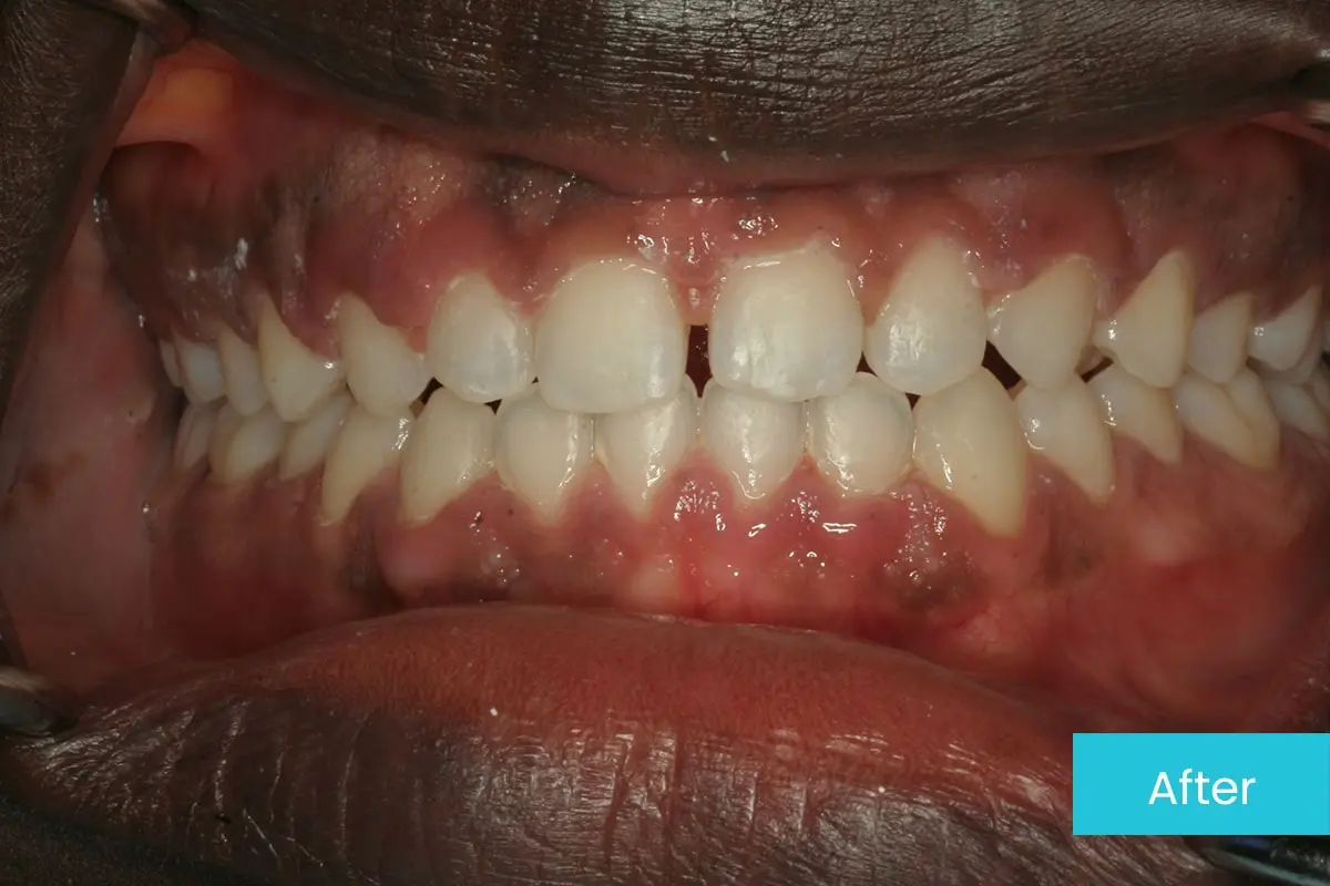 Invisalign For Open Bite Case 2 After