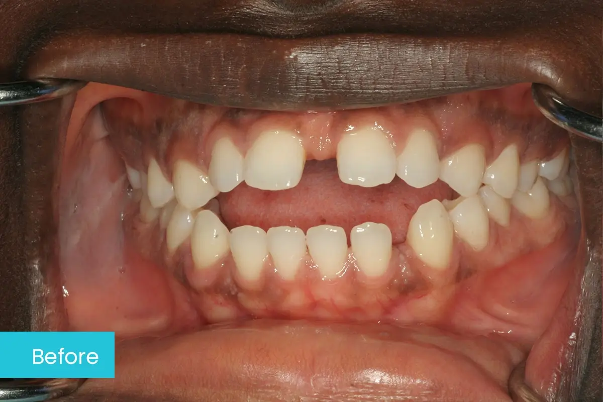 Invisalign For Open Bite Case 2 Before