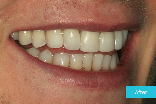 Invisalign After