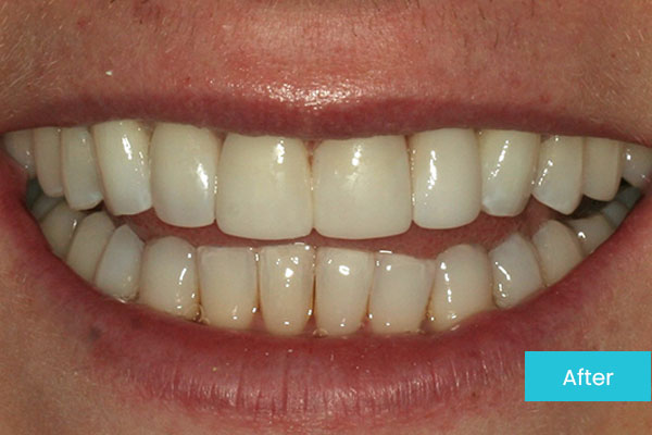 Invisalign After 1