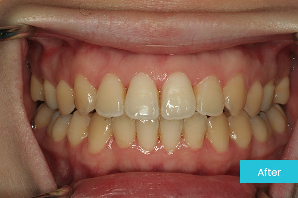 Invisalign After 2