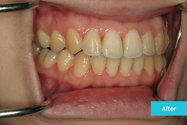 Invisalign After 3