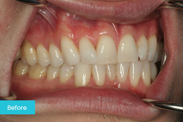 Invisalign Before
