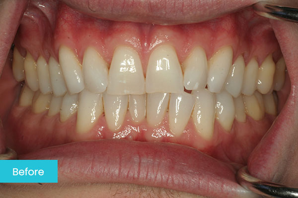 Invisalign Before 1