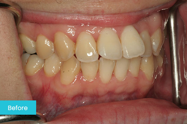 Invisalign Before 3