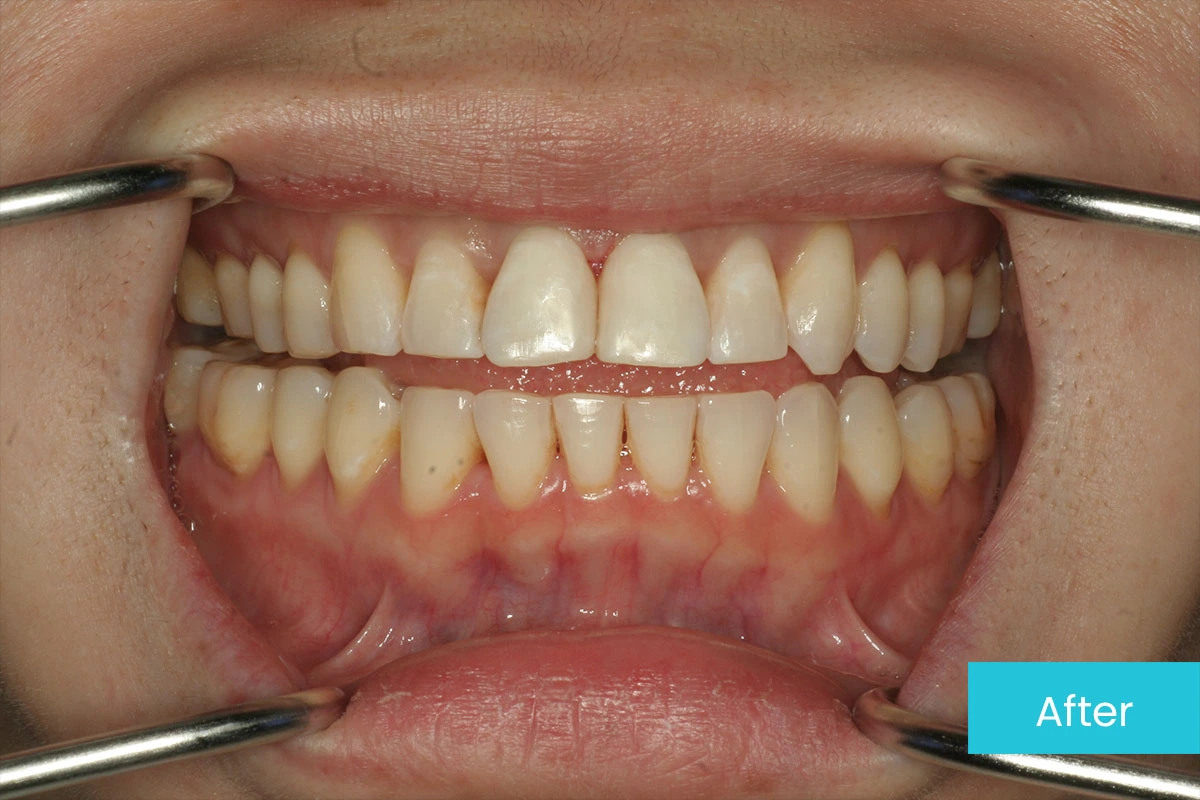 Invisalign 1 After